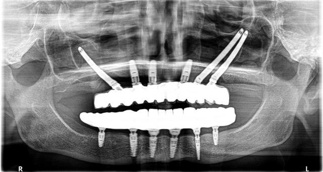 Implantologia stomatologiczna